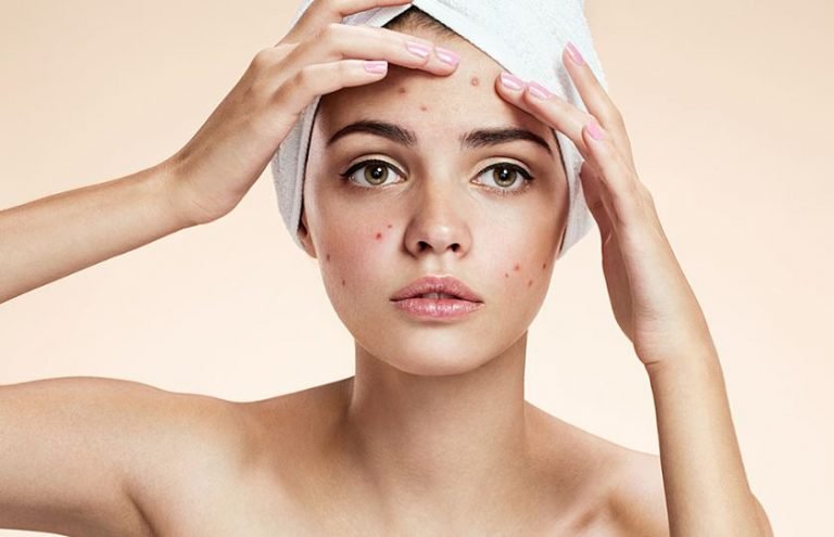 How to Treat Acne-Prone Skin